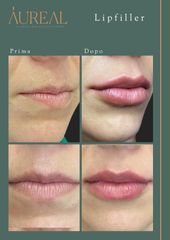 LIPFILLER - Aureal | Glamour Medical Experience