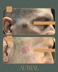 Aurial | Glamour Medical Experience neoformazioni