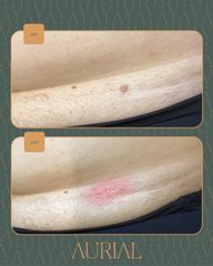 Aurial | Glamour Medical Experience neoformazioni