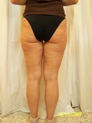 Cellulite prima