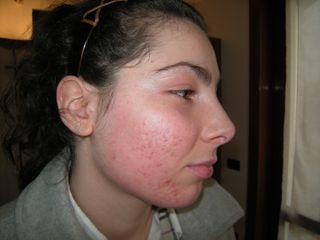 cicatrici acne