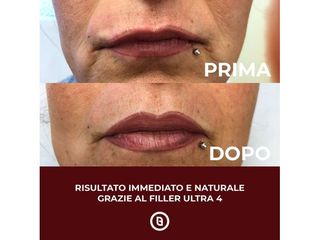 Filler labbra prima e dopo