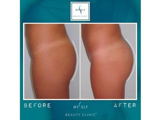 Gluteoplastica prima dopo
