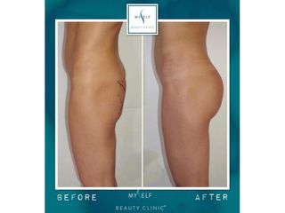 Gluteoplastica prima dopo