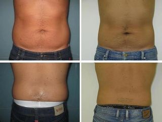 Coolsculpting prima e dopo