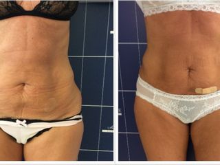 Liposuzione prima e dopo