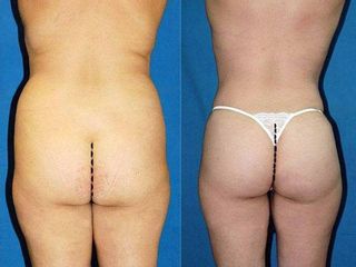 lipofilling Gluteo prima e dopo