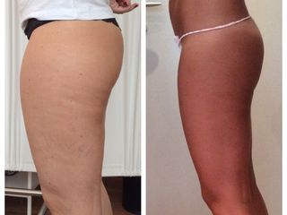 Body Contouring prima e dopo