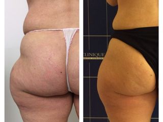 Criolipolisi prima e dopo