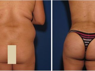 Liposuzione e Lipofilling glutei prima e dopo