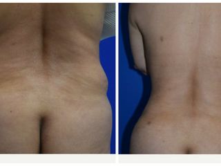 BodyTite prima e dopo