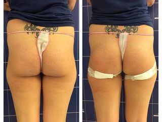 Aumento glutei prima e dopo