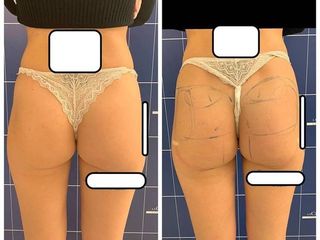 Lifting glutei prima e dopo