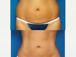 BodyTite prima e dopo