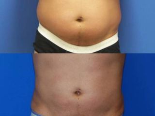 BodyTite prima e dopo