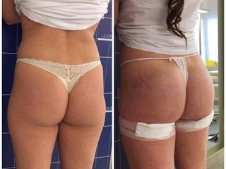 Aumento glutei prima e dopo