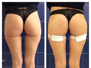 Aumento glutei prima e dopo