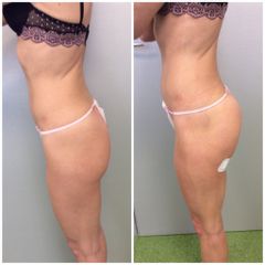 Gluteoplastica prima e dopo