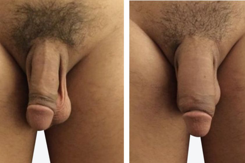 Ingrossamento pene prima e dopo - 773964