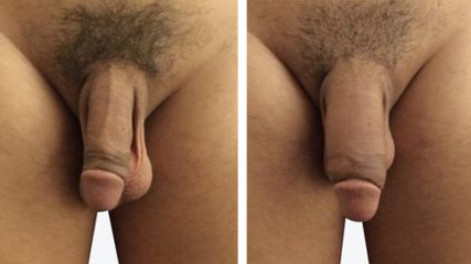Ingrandimento Pene - LaCLINIQUE of Switzerland®
