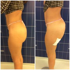 LOS DELINE GLUTEI 