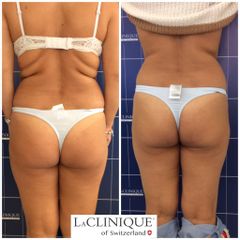 Criolipolisi - LaCLINIQUE of Switzerland®
