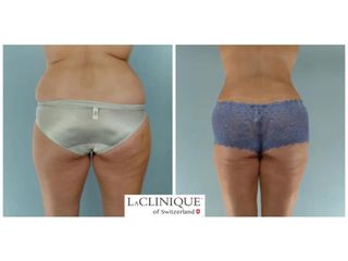 Criolipolisi - LaCLINIQUE of Switzerland®