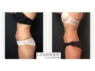 Criolipolisi - LaCLINIQUE of Switzerland®