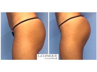 Gluteoplastica - LaCLINIQUE of Switzerland®