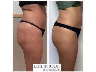 Gluteoplastica - LaCLINIQUE of Switzerland®