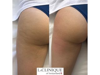 Smagliature - LaCLINIQUE of Switzerland®