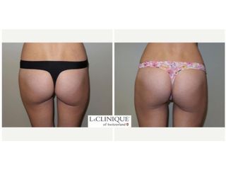 Gluteoplastica - LaCLINIQUE of Switzerland®