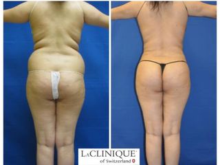Liposuzione - LaCLINIQUE of Switzerland®