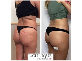 Gluteoplastica - LaCLINIQUE of Switzerland®