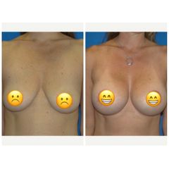 Mastopessi - LaCLINIQUE of Switzerland®