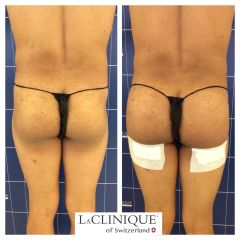 Gluteoplastica - LaCLINIQUE of Switzerland®