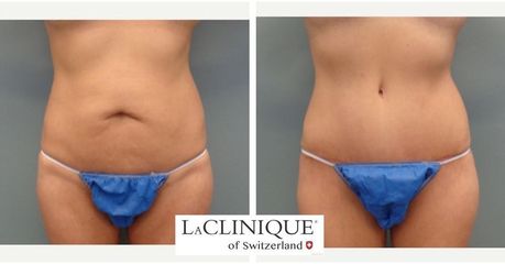 Addominoplastica - LaCLINIQUE of Switzerland®