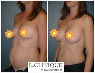 Mommy makeover - LaCLINIQUE of Switzerland®