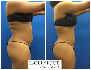 Liposcultura - LaCLINIQUE of Switzerland®