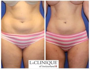 Liposuzione - LaCLINIQUE of Switzerland®