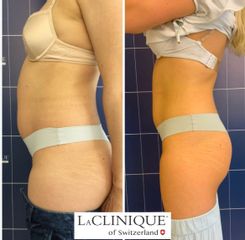 Liposuzione - LaCLINIQUE of Switzerland