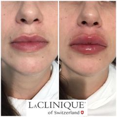 Filler Labbra - LaCLINIQUE of Switzerland