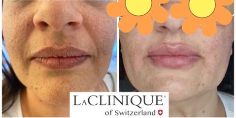 Filler Viso e Labbra - LaCLINIQUE of Switzerland