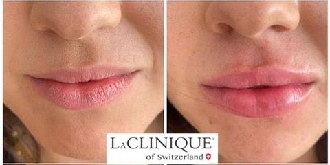 Filler Labbra - LaCLINIQUE of Switzerland