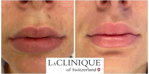 Filler Labbra - LaCLINIQUE of Switzerland
