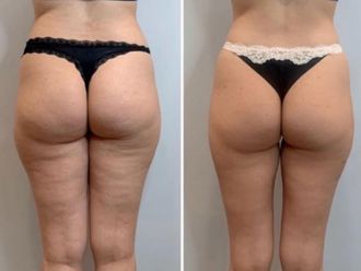 Laserterapia prima e dopo - 860741