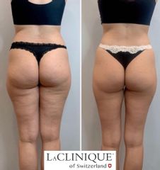 Rimodellamento con Laser