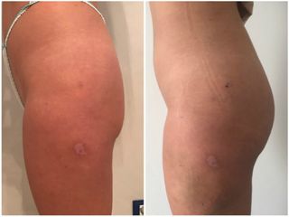 Liposcultura prima e dopo