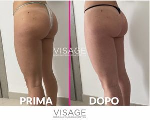 Radiofrequenza - Visage Medicina e Chirurgia Estetica