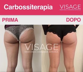 Carbossiterapia - Visage Medicina e Chirurgia Estetica